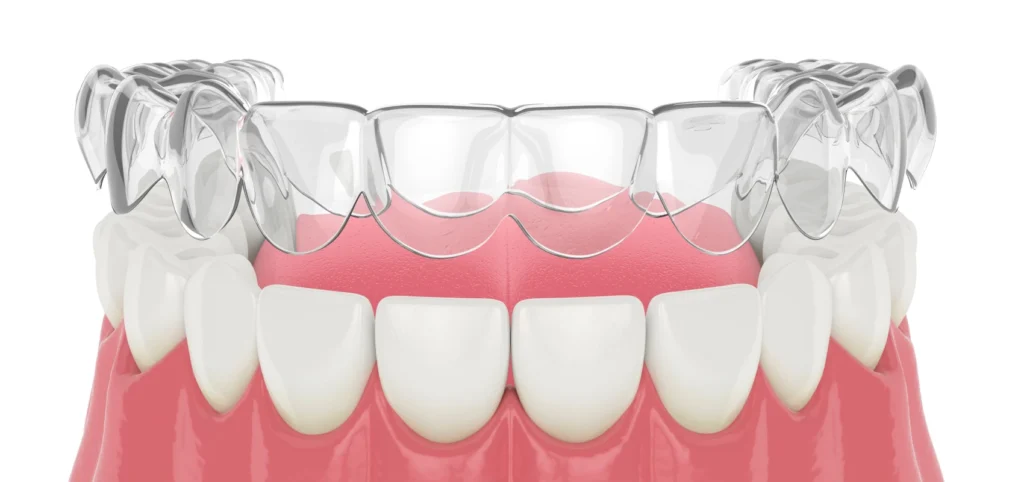 Orthodontiste à Meylan - contention